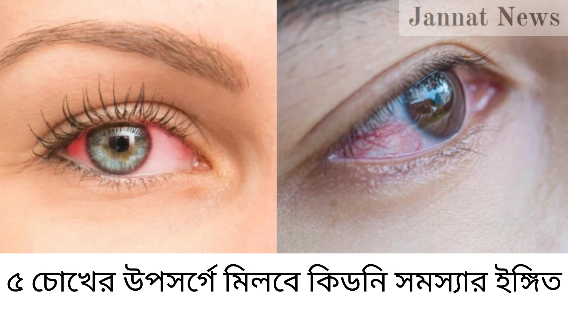 ৫ চোখের উপসর্গে মিলবে কিডনি সমস্যার ইঙ্গিত