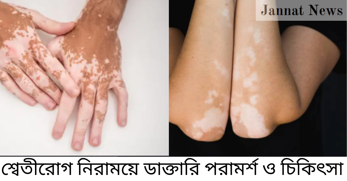 শ্বেতীরোগ নিরাময়ে ডাক্তারি পরামর্শ ও চিকিৎসা