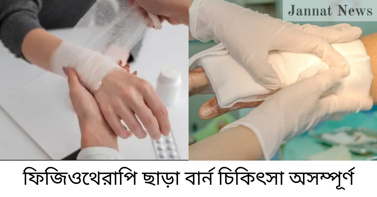 ফিজিওথেরাপি ছাড়া বার্ন চিকিৎসা অসম্পূর্ণ কেন?