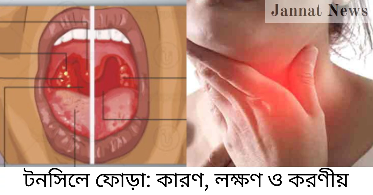 টনসিলে ফোড়া: কারণ, লক্ষণ ও করণীয়
